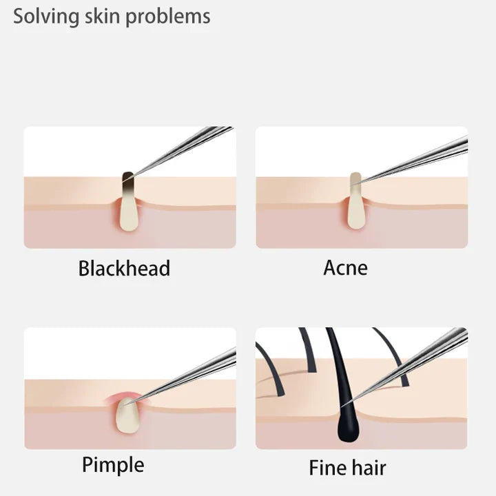 perofessional facial blackheads remover