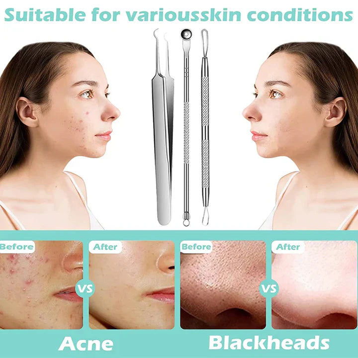 perofessional facial blackheads remover